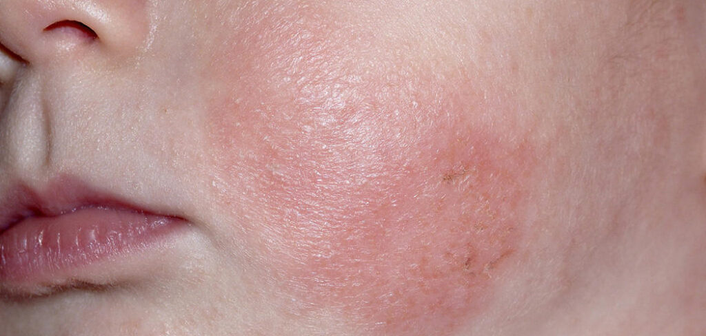How to Help Baby Acne in Your Newborn