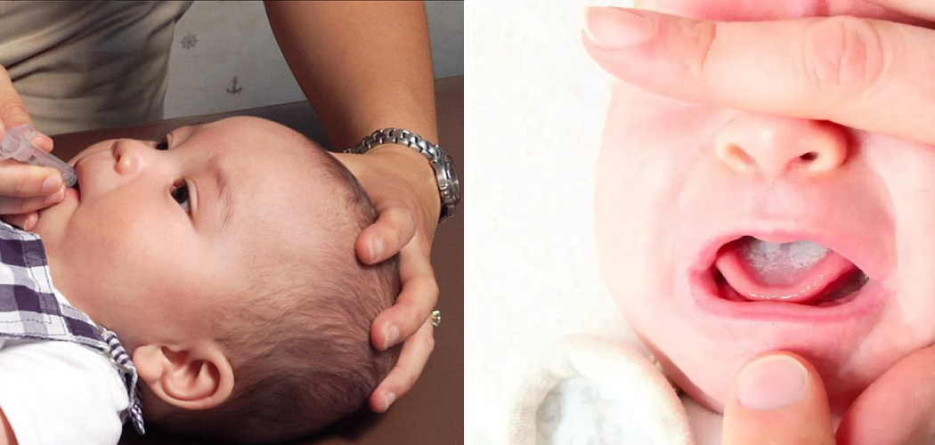 How to Apply Nystatin Drops for Babies