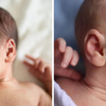 How to Get Rid of Baby Acne Fast