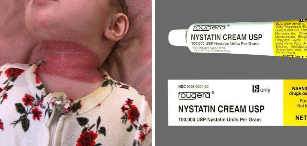 How to Use Nystatin Cream for Babies